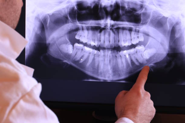 Best Emergency Wisdom Tooth Extraction in Cheltenham Village, PA